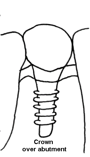 drawing three of dental implant